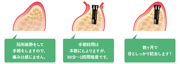 外科的処置・インプラント埋入