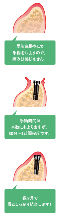 外科的処置・インプラント埋入