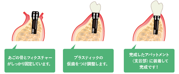 歯の土台の装着・人工歯の装着