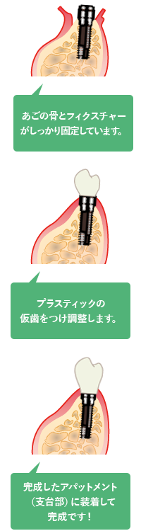 歯の土台の装着・人工歯の装着
